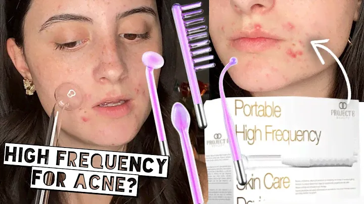 TESTING HIGH FREQUENCY ON ACNE FOR 2 WEEKS | Project E Beauty Argon High Frequency Skincare Device